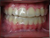 MTM Clear Aligners