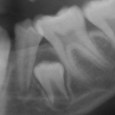 blocked tooth