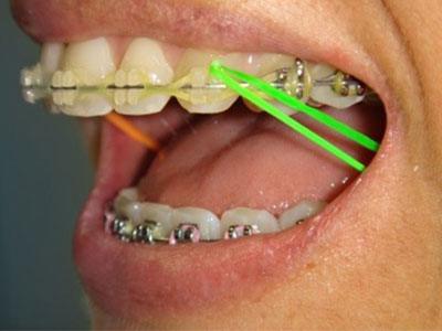 Elastics on braces