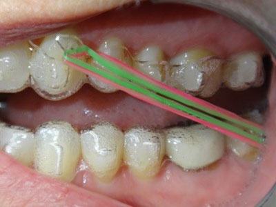 Elastics on teeth