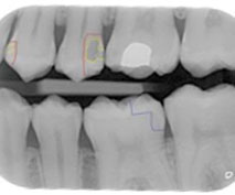 Front XRay