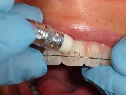 Emergency Orthodontic Care